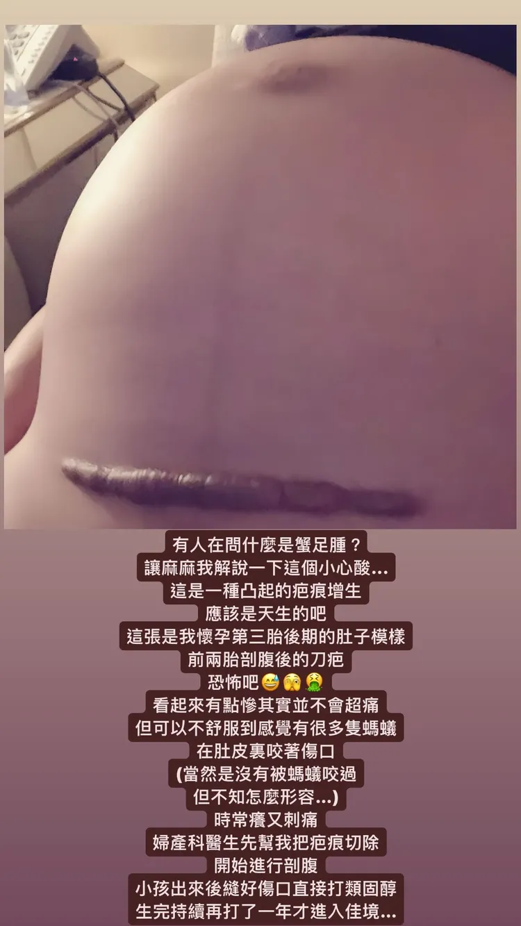關穎剖腹的刀疤因為蟹足腫相當粗。翻攝kwanterri IG
