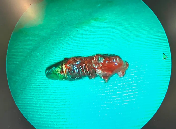 取出的植牙體，總長度約2公分。院方提供