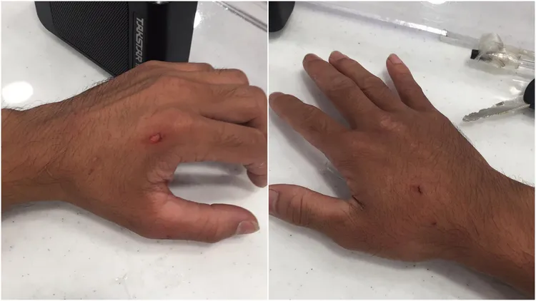 外送員出示遭歹徒毆打傷勢。翻攝自《香港01》