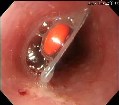 藥丸和鋁箔包裝吞下肚！如刀片卡在食道照曝光。翻攝臉書「錢政弘 胃腸肝膽科醫師」