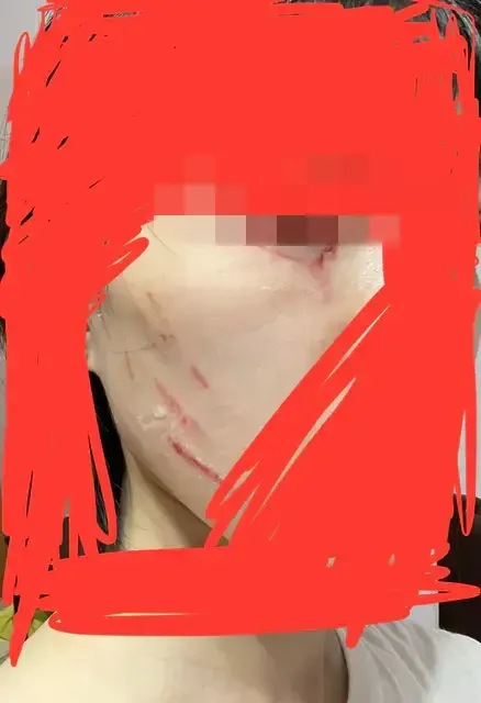 女子臉上抓痕明顯。翻攝自Dcard