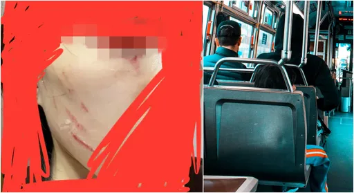 搭公車「眼球遭重擊」毀容 竟沒人幫忙!她心寒:被打死也沒人在乎