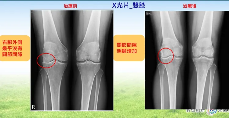 X光影像可見錢薇娟雙膝關節空隙在治療後明顯增加。新光醫院提供