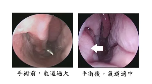 三度手術反致空鼻症!鼻內亂流害她呼吸困難 失眠又憂鬱