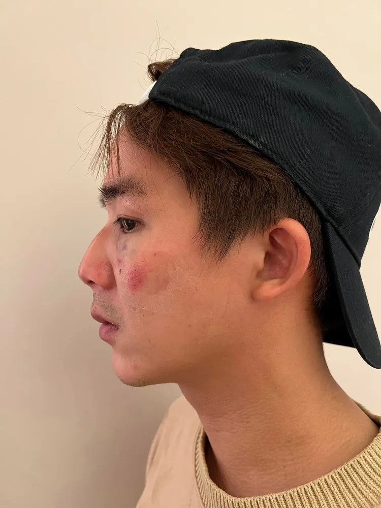 李博翔街頭遭毆傷。取自李博翔社群