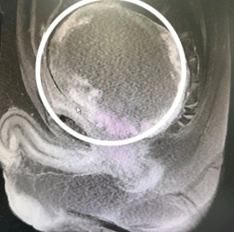 趙先生斷層檢查可見腫瘤位置及大小。阮綜合提供