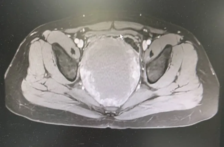 趙先生斷層檢查可見腫瘤位置及大小。阮綜合提供