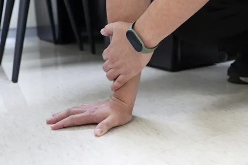 跌倒手掌撐地「啪」一聲!掌骨斷3塊 鋼板復位術後一週復原