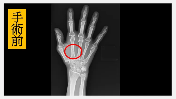 手術前X光片發現，病患的右手第二掌骨粉碎性骨折合併錯位（紅圈處）。院方提供