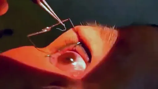 她揉眼「掉出一尾活蟲」 就醫竟揪出60多條蟲住在眼睛裡