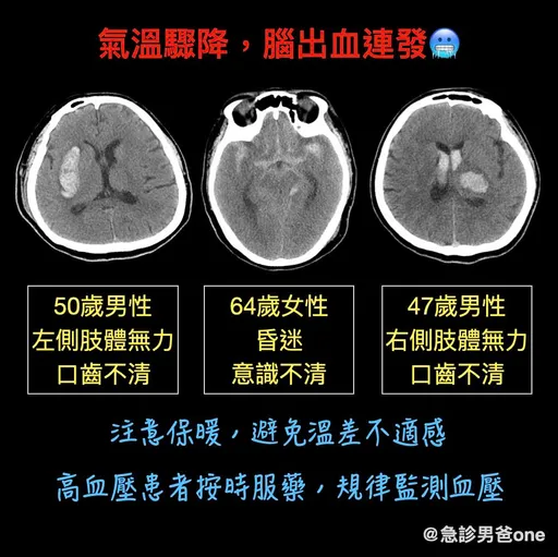 「急診1小時送來3個腦出血病患」　今晚探6˚C！醫師：還會直線上升