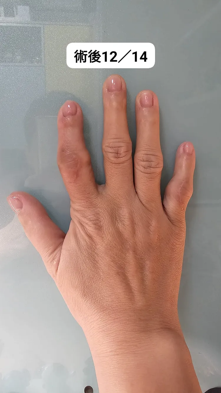 王瑞玲「雞爪指」術後模樣。翻攝自王瑞玲臉書