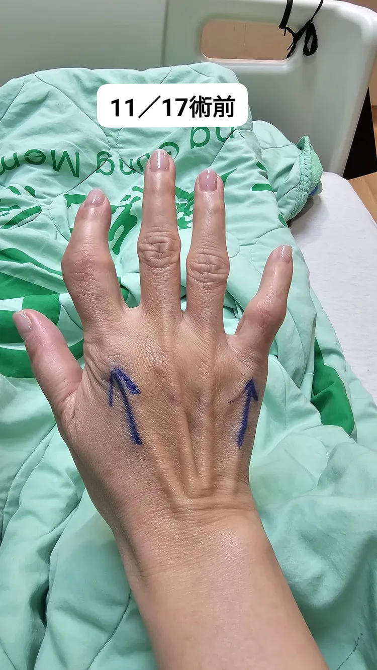 王瑞玲「雞爪指」術前模樣。翻攝自王瑞玲臉書