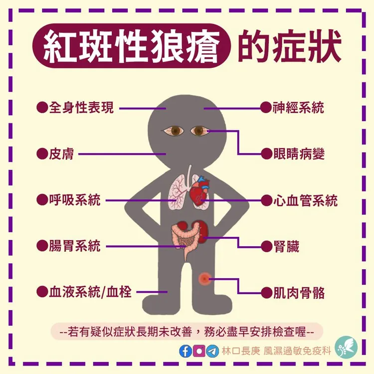 紅斑性狼瘡症狀。翻攝臉書「林口長庚風濕過敏免疫科」
