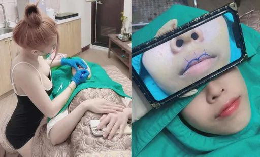 逃逸女移工年收百萬！竟成整形「名醫」　指定她剪唇「M字型」