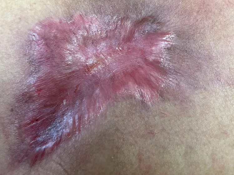 傷口逐漸收合。院方提供