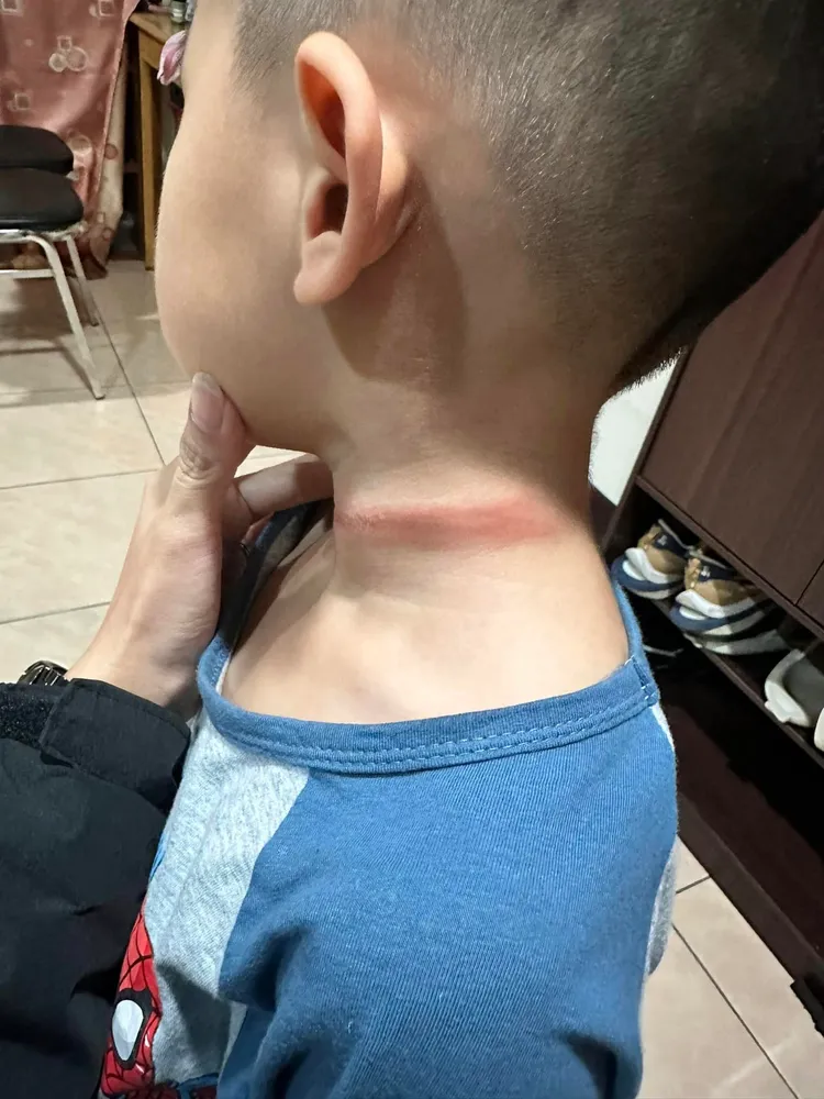 幼童遭勒頸受傷。翻爆料公社二社