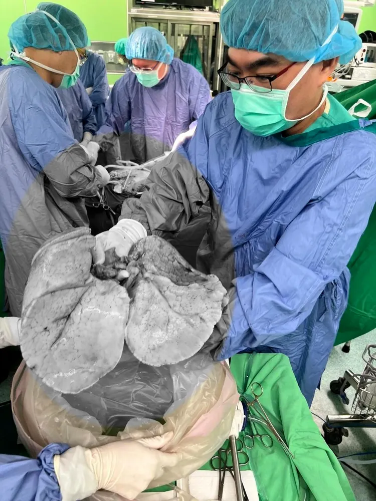 大愛捐贈肺臟者是一名39歲男性，因車禍腦死。三總提供