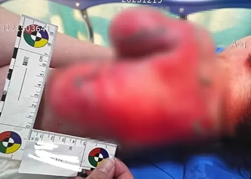 托嬰中心男嬰50%二度燒燙傷 竹市府介入調查!托育員最重可罰60萬