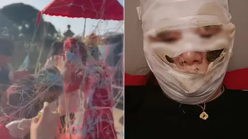 婚禮賓客狂噴彩帶 新娘「臉部燙傷」狂冒水泡險毀容