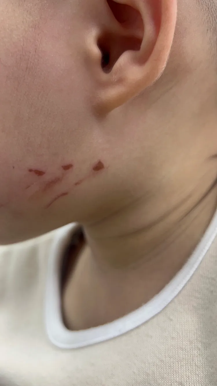 男童臉被抓傷。翻攝畫面