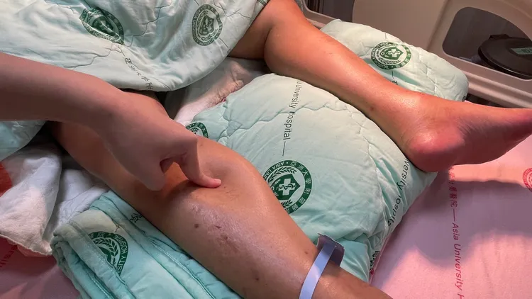 患者因莫名下肢水腫就醫，才發現竟然罹患紅斑性狼瘡。院方提供