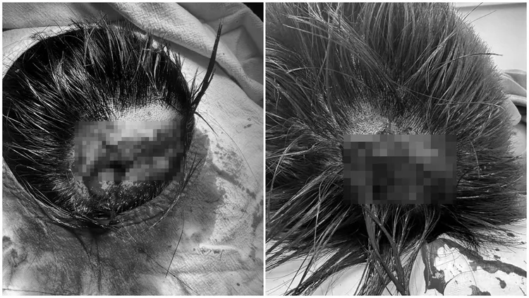 Toyz後腦被「開瓢」，林姓網友說，傷勢照片是Toyz親自傳給他，千真萬確。翻攝自林男臉書