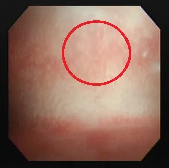 不孕症醫療團隊透過詳細檢查，揪出不孕原因，圖為子宮內膜炎內視鏡檢查圖片。院方提供