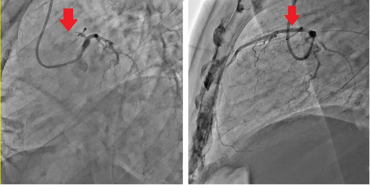 患者血管嚴重狹窄(左)，打通後恢復血流(右)。院方提供