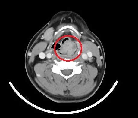 王男喉嚨處發現一顆將近3公分大的腫瘤，喉道僅剩些微的縫隙能維持。院方提供