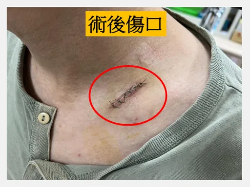 46歲男頸部腫塊半年來逐漸變大　竟是罕見副神經髓鞘瘤