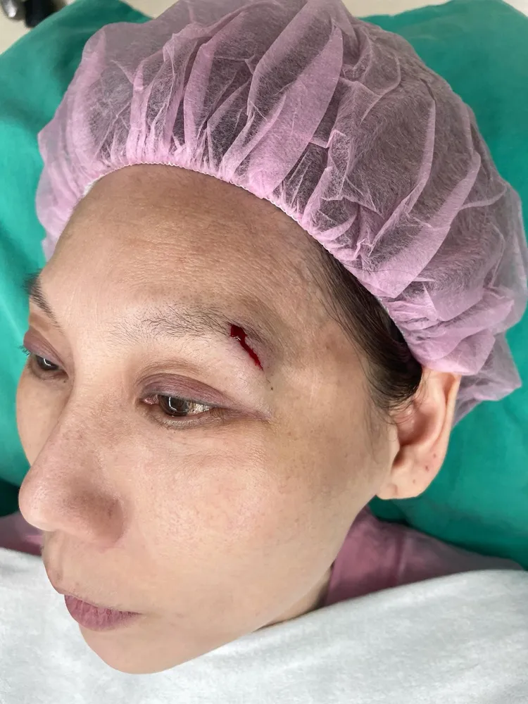 郎祖筠的傷口內外共縫11針。翻攝自郎祖筠臉書
