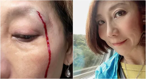 郎祖筠濺血!臉撞壁角「傷口裂開流一手血」 曝全身55針傷疤史