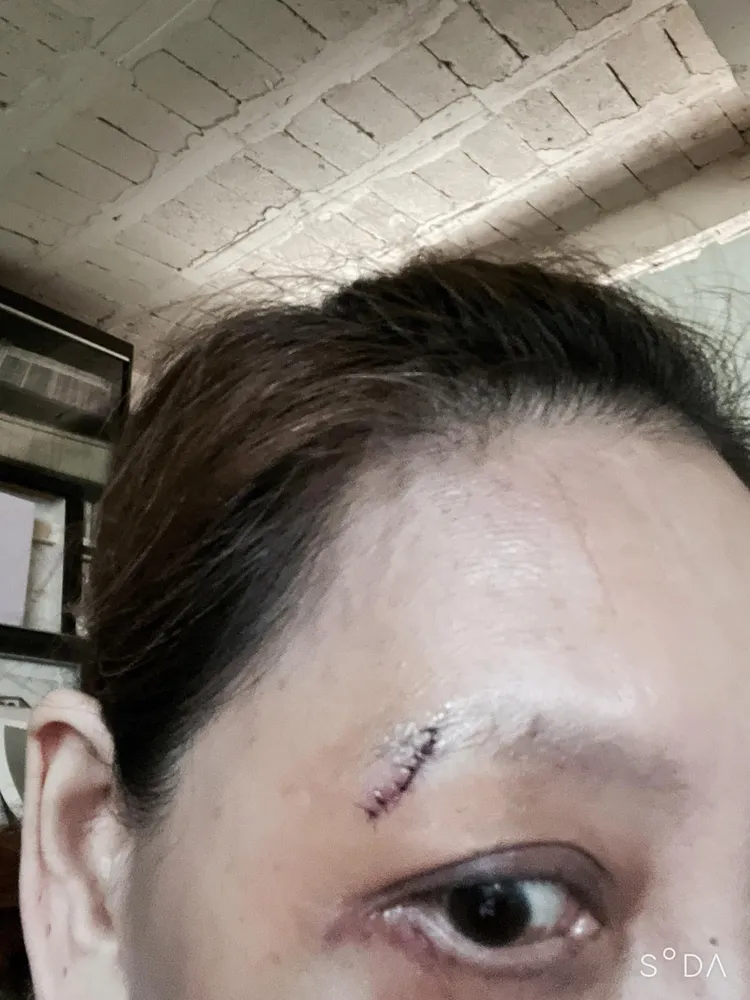 郎祖筠縫合11針，昨天進行拆線。翻攝自郎祖筠臉書
