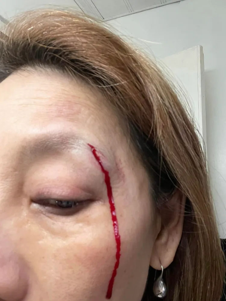 郎祖筠受傷照讓粉絲擔心不已。翻攝自郎祖筠臉書
