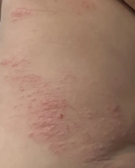 手足口病的會在身體出現紅疹或水泡。書田診所提供