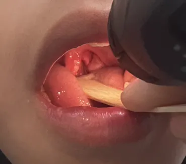 十歲小柏的軟顎及懸壅垂出現潰瘍。醫師蘇軏提供