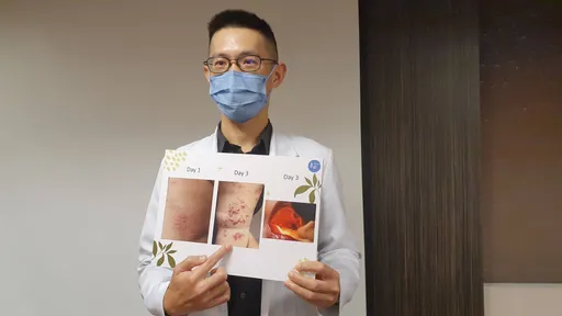 10歲童高燒錯當流感!腳底冒紅疹、喉嚨潰瘍 才知腸病毒惹禍