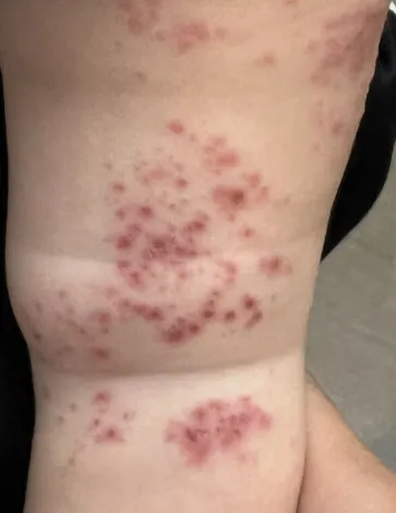 一歲小安的軀幹出現一顆一顆的丘疹和水泡。醫師蘇軏提供