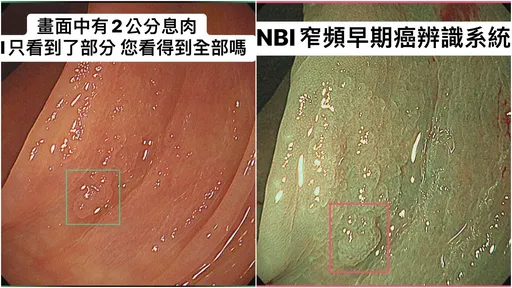 AI大肠镜都低估!连粪便潜血也不易侦测 医曝这款大肠癌悄袭45岁以下