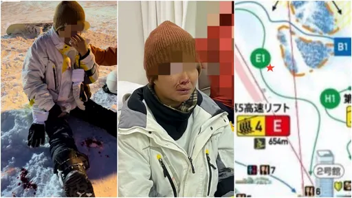 台女赴日滑雪遭港情侶「肇事逃逸」 她破相縫7針!友怒PO網求肉搜