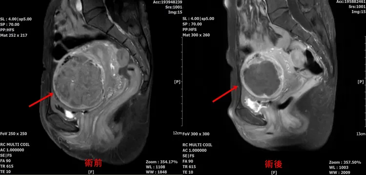 術前術後比較。院方提供