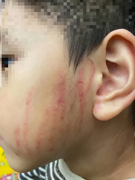 台中4歲男童左臉驚現10條血痕！幼保員抓的　理由竟是這個