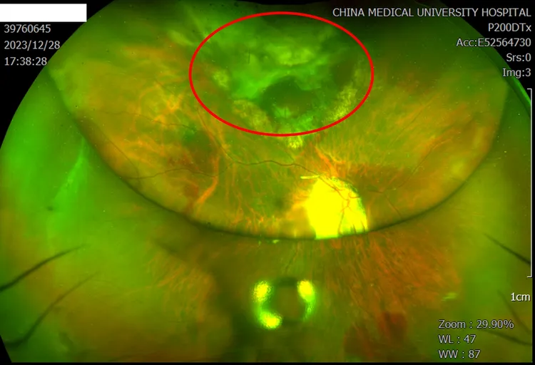 手術除脈絡膜惡性黑色素瘤，成功保留眼球。院方提供
