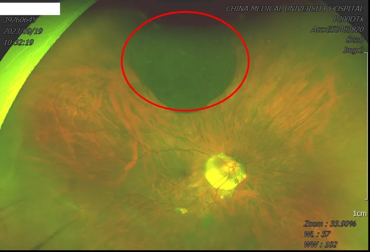 陳小姐因惡性黑色素腫瘤造成視覺一片霧茫茫。院方提供