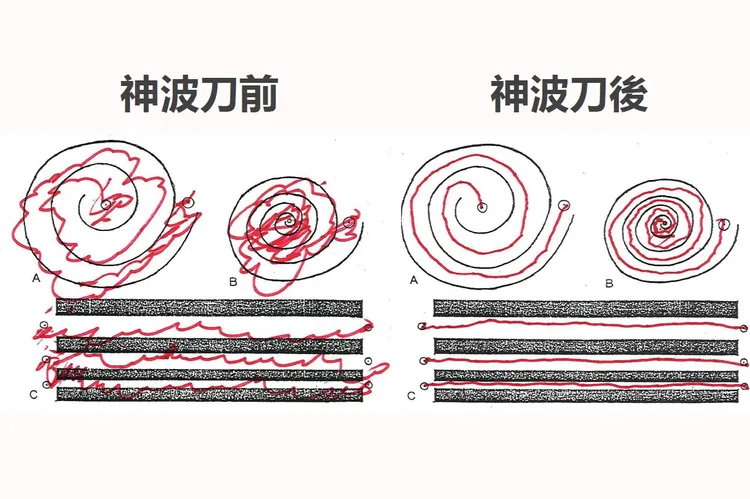 3小時神波刀治療前後，病人拿筆畫圖對照。北榮提供