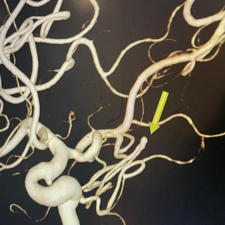 慈濟醫院ICU美女護理師林婷表示，曾遇過開票夜熱情支持者太激情導致腦出血送醫，已經嘴歪臉斜還在喊「凍蒜」。翻攝《林婷一下吧 icu護理師》