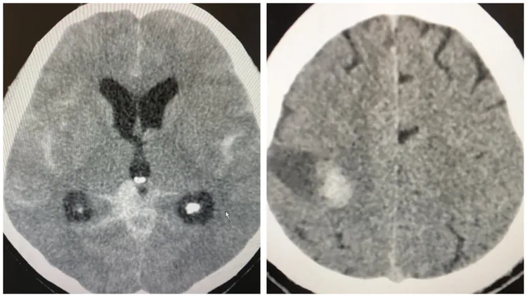 慈濟醫院ICU美女護理師林婷表示，曾遇過開票夜熱情支持者太激情導致腦出血送醫，已經嘴歪臉斜還在喊「凍蒜」。翻攝《林婷一下吧 icu護理師》