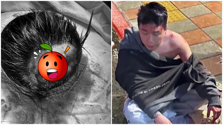 Toyz（劉偉健）被超哥扁到腦袋開花。翻攝自林男臉書