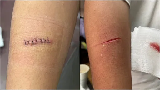 國中生遭摺疊刀割10公分「因好奇」 家長報警PO網怒:無法原諒